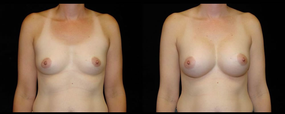 Breast Augmentation Before & After Patient #968