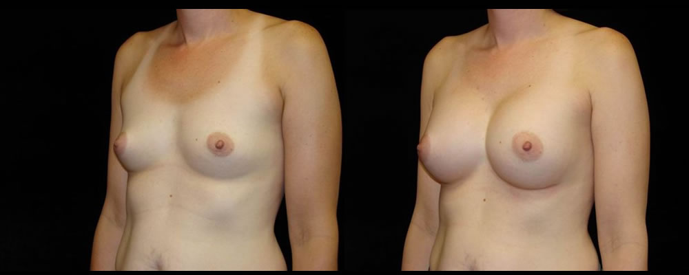 Breast Augmentation Before & After Patient #968