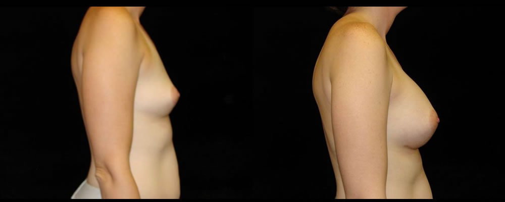 Breast Augmentation Before & After Patient #968