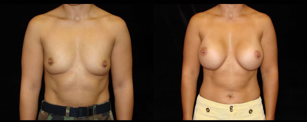 Breast Augmentation Before & After Patient #964