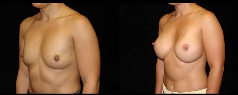 Breast Augmentation Before & After Patient #964