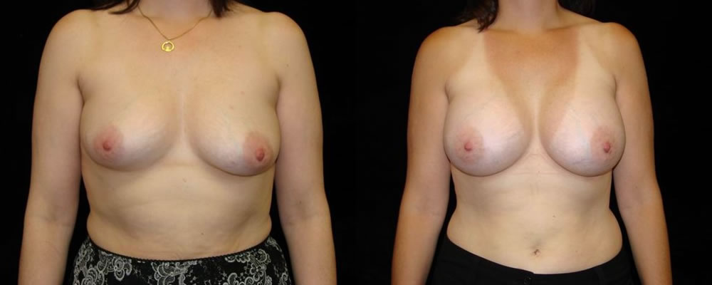 Breast Augmentation Before & After Patient #956