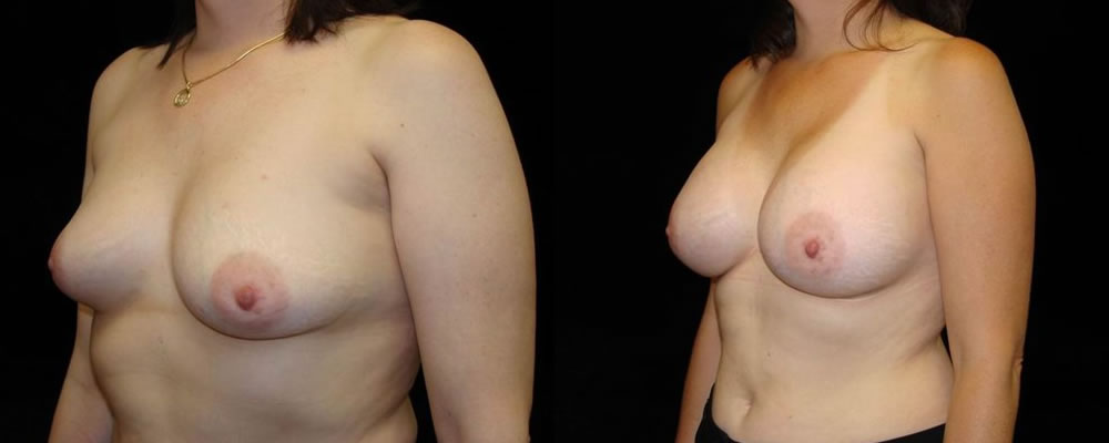 Breast Augmentation Before & After Patient #956