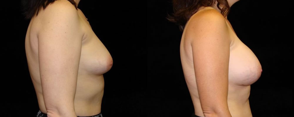 Breast Augmentation Before & After Patient #956