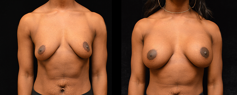 Breast Augmentation Before & After Patient #1005