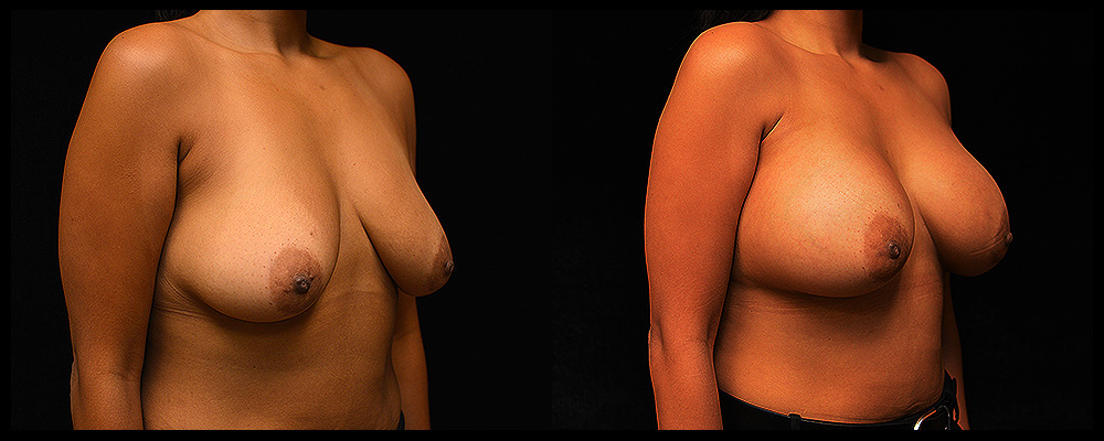 Breast Augmentation Before & After Patient #1001