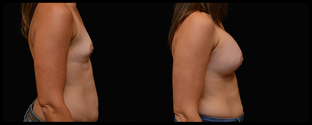 Breast Augmentation Before & After Patient #999