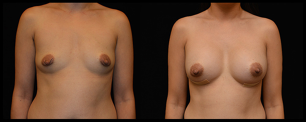 Breast Augmentation Before & After Patient #994