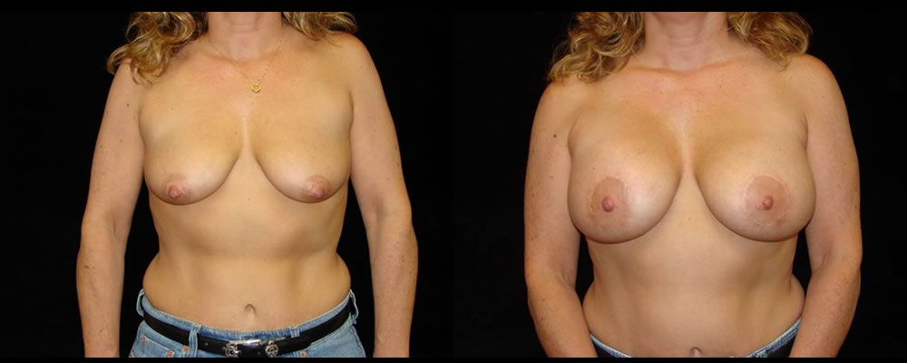 Breast Augmentation with Lift Before & After Patient #1048