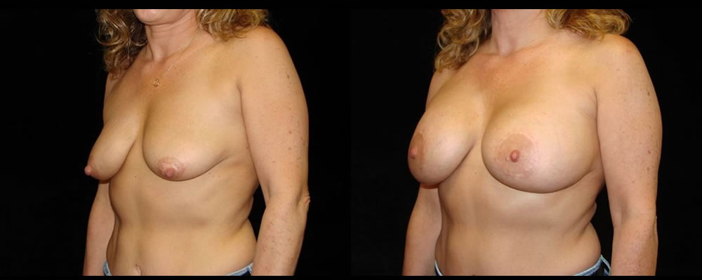 Breast Augmentation with Lift Before & After Patient #1048