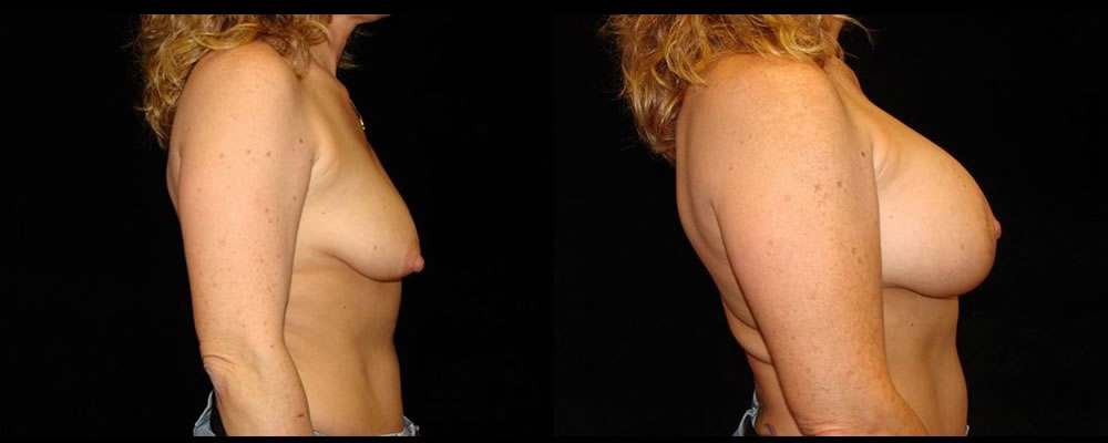 Breast Augmentation with Lift Before & After Patient #1048