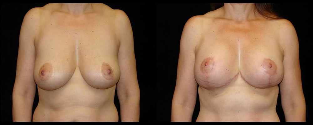 Breast Lift Before & After Patient #1052