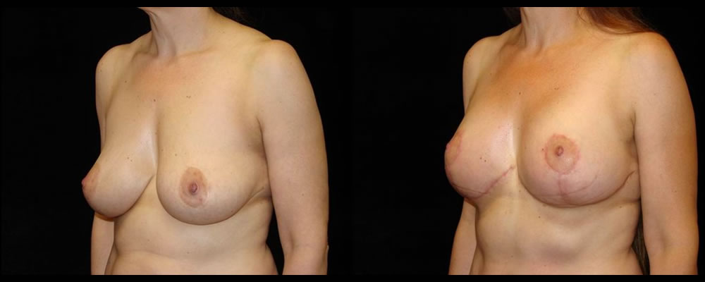 Breast Lift Before & After Patient #1052