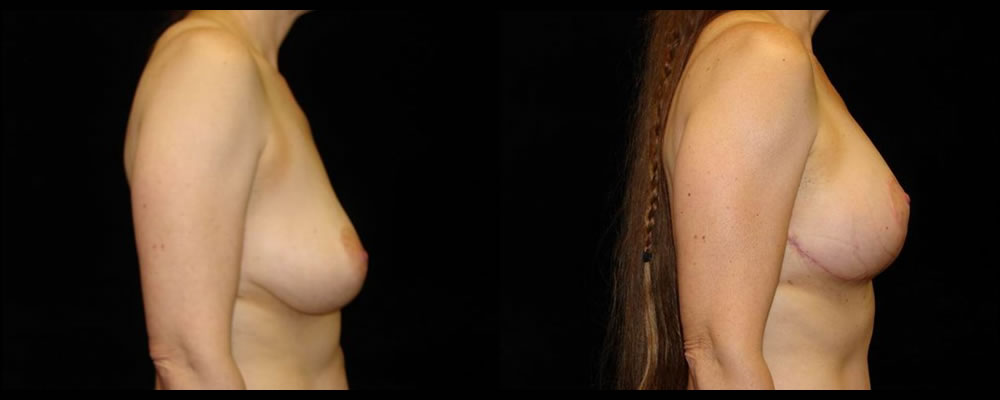 Breast Lift Before & After Patient #1052