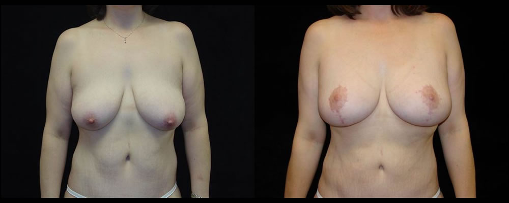 Breast Lift Before & After Patient #1056