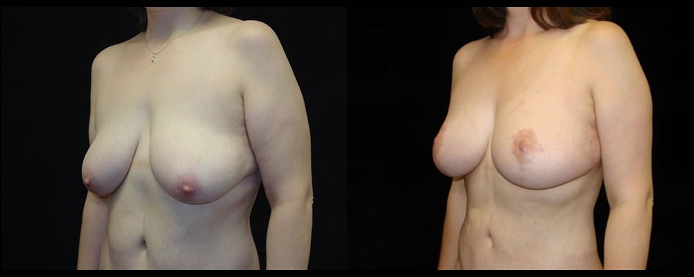 Breast Lift Before & After Patient #1056