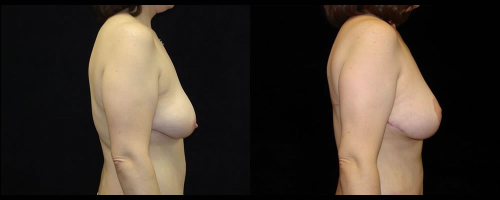 Breast Lift Before & After Patient #1056