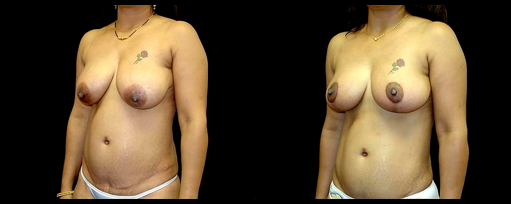 Breast Lift Before & After Patient #1060