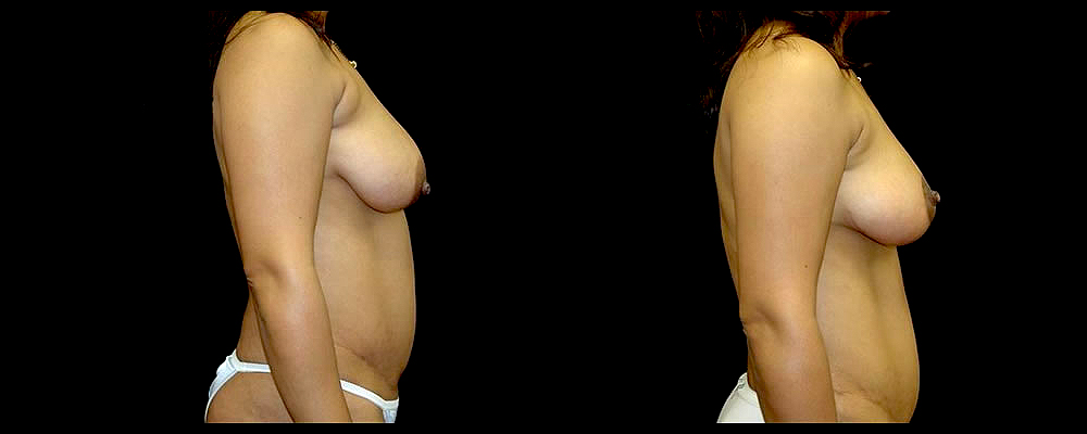 Breast Lift Before & After Patient #1060