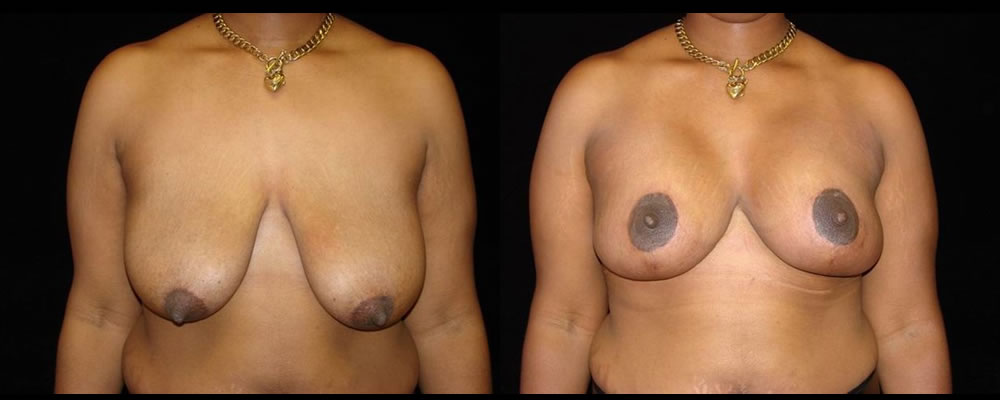 Breast Augmentation with Lift Before & After Patient #1044