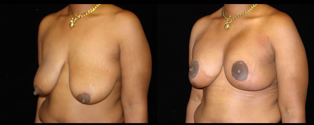 Breast Augmentation with Lift Before & After Patient #1044