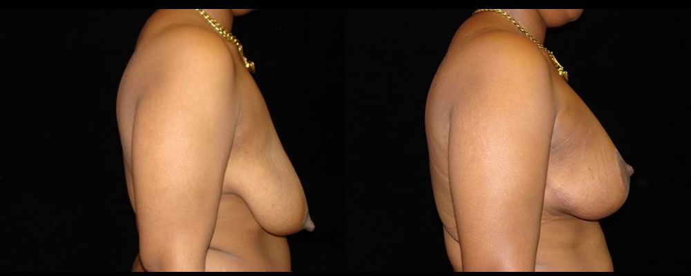 Breast Augmentation with Lift Before & After Patient #1044