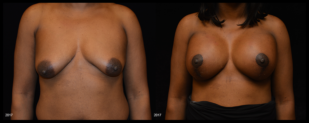 Breast Augmentation with Lift Before & After Patient #1019