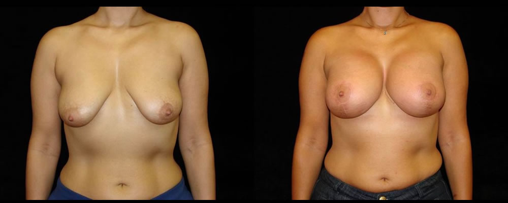 Breast Augmentation with Lift Before & After Patient #1040