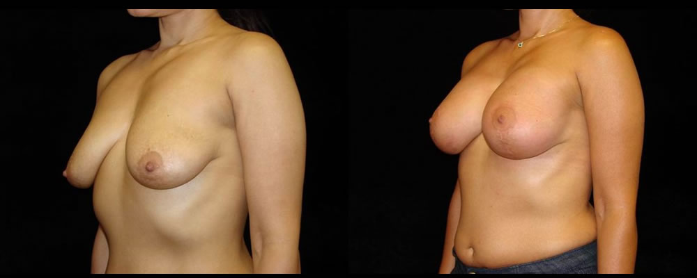 Breast Augmentation with Lift Before & After Patient #1040