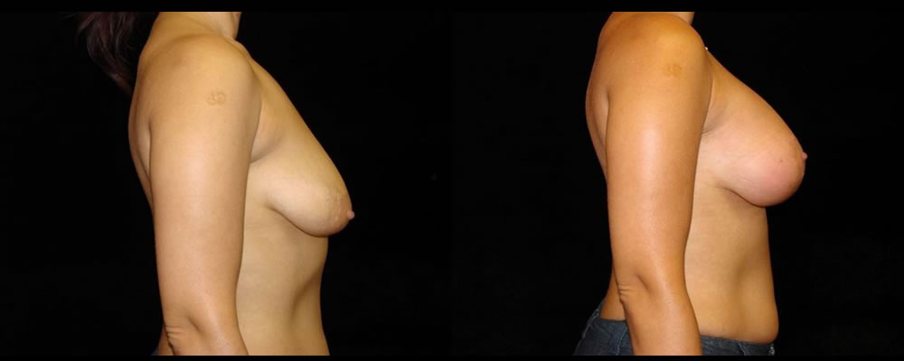 Breast Augmentation with Lift Before & After Patient #1040