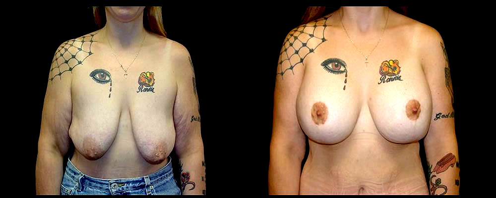 Breast Augmentation with Lift Before & After Patient #1036