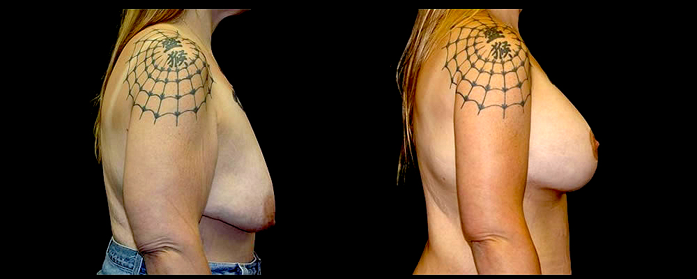Breast Augmentation with Lift Before & After Patient #1036