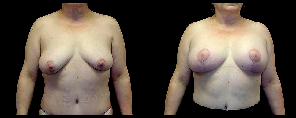 Breast Augmentation with Lift Before & After Patient #1033