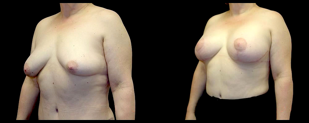 Breast Augmentation with Lift Before & After Patient #1033