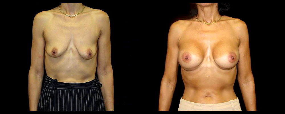 Breast Augmentation with Lift Before & After Patient #1029