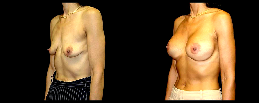 Breast Augmentation with Lift Before & After Patient #1029