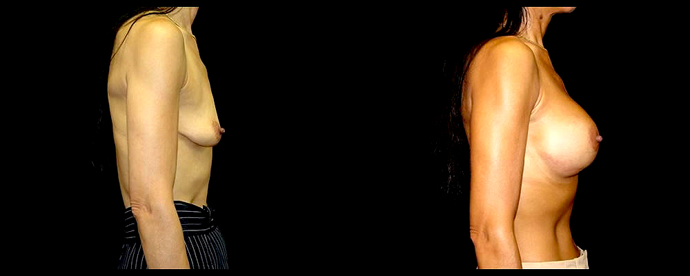 Breast Augmentation with Lift Before & After Patient #1029