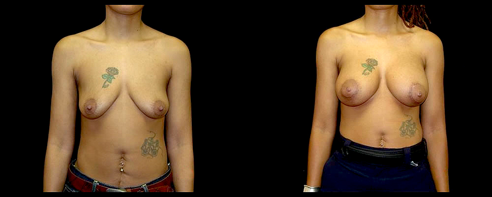 Breast Augmentation with Lift Before & After Patient #1025