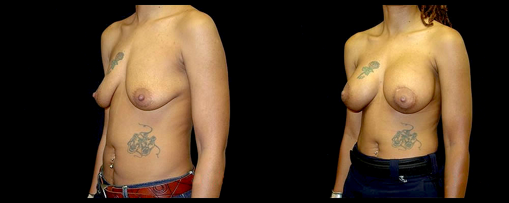 Breast Augmentation with Lift Before & After Patient #1025