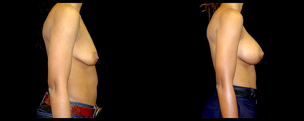 Breast Augmentation with Lift Before & After Patient #1025