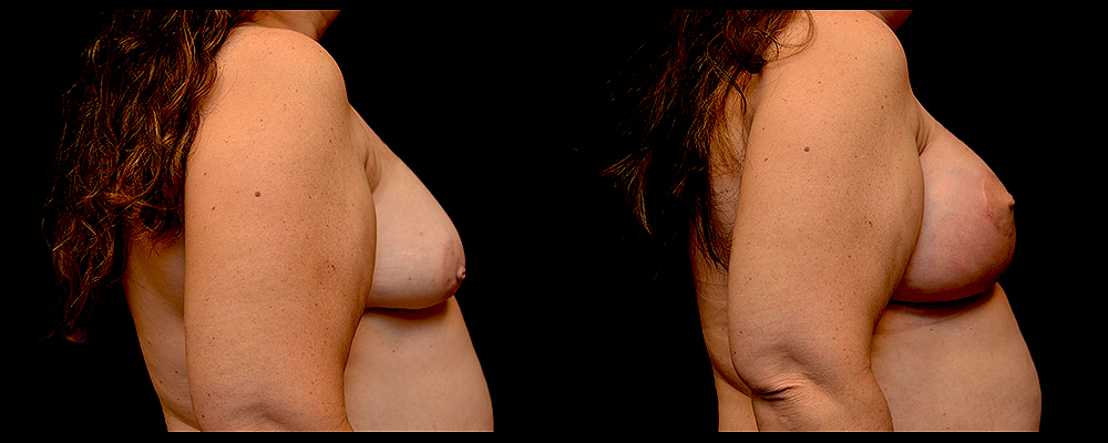 Breast Augmentation with Lift Before & After Patient #1021
