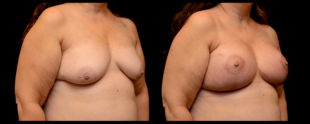 Breast Augmentation with Lift Before & After Patient #1021