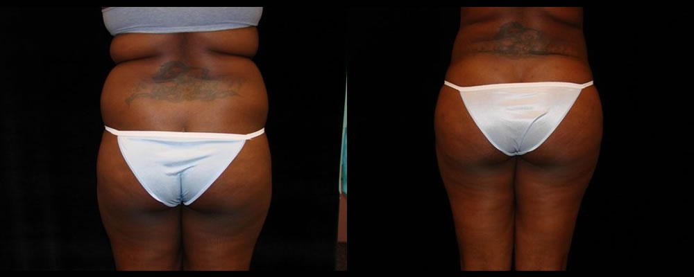 Brazilian Butt Lift Before & After Patient #779