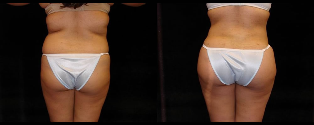 Brazilian Butt Lift Before & After Patient #743