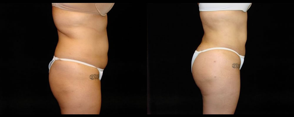 Brazilian Butt Lift Before & After Patient #743