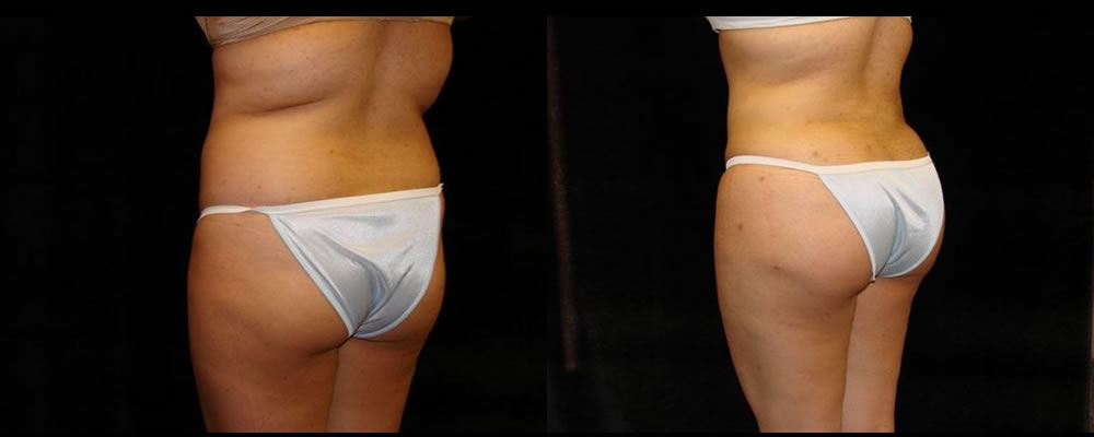 Brazilian Butt Lift Before & After Patient #743
