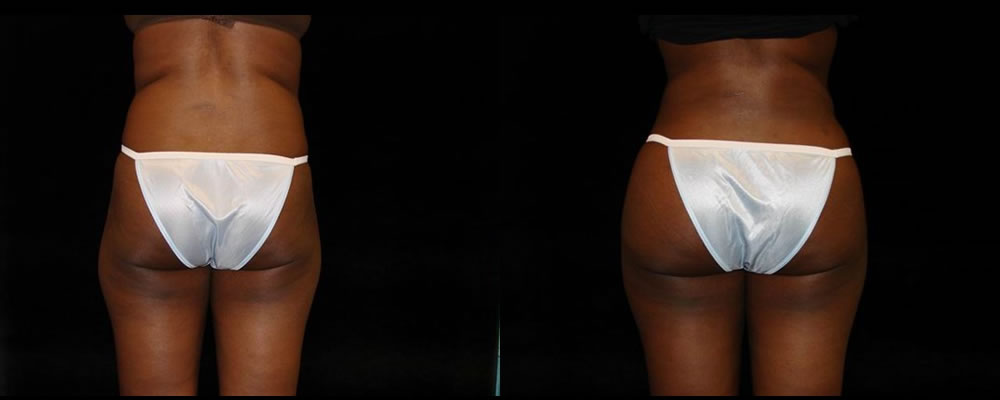 Brazilian Butt Lift Before & After Patient #739