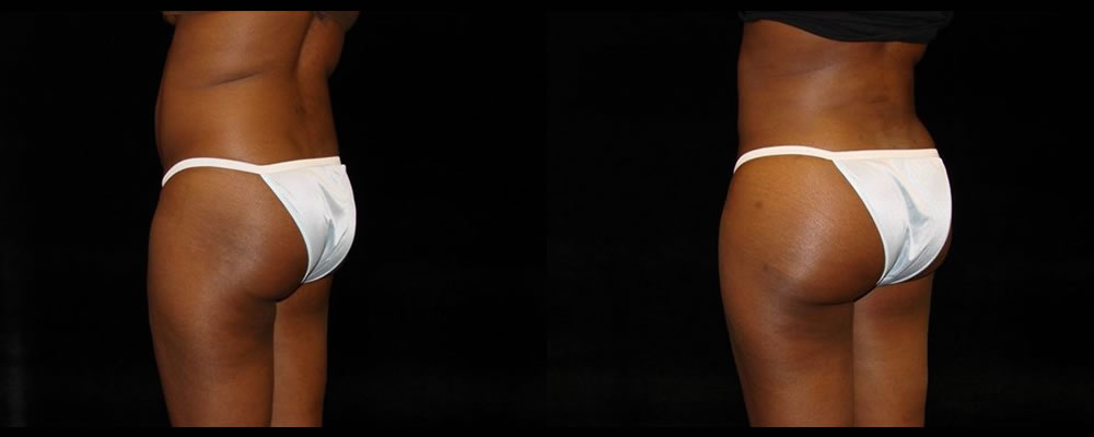 Brazilian Butt Lift Before & After Patient #739