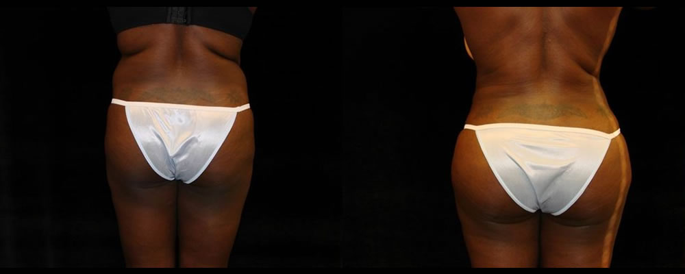 Brazilian Butt Lift Before & After Patient #735
