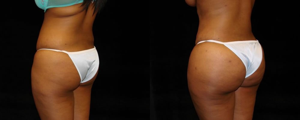 Brazilian Butt Lift Before & After Patient #731
